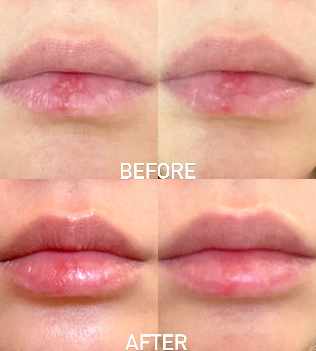 Hydroslime™ Lip Masks